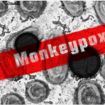Monkeypox Guide in English & Urdu, Symptoms, Vaccine, Treatment, Causes, Precautions